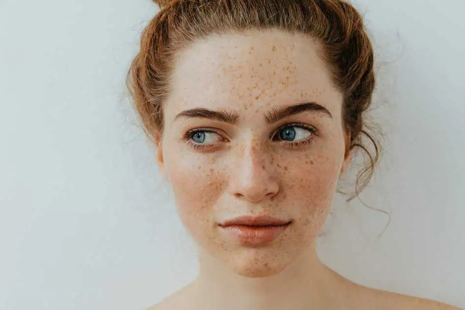 Freckles and Sun Spots Removal by Isya Aesthetics In Delhi India