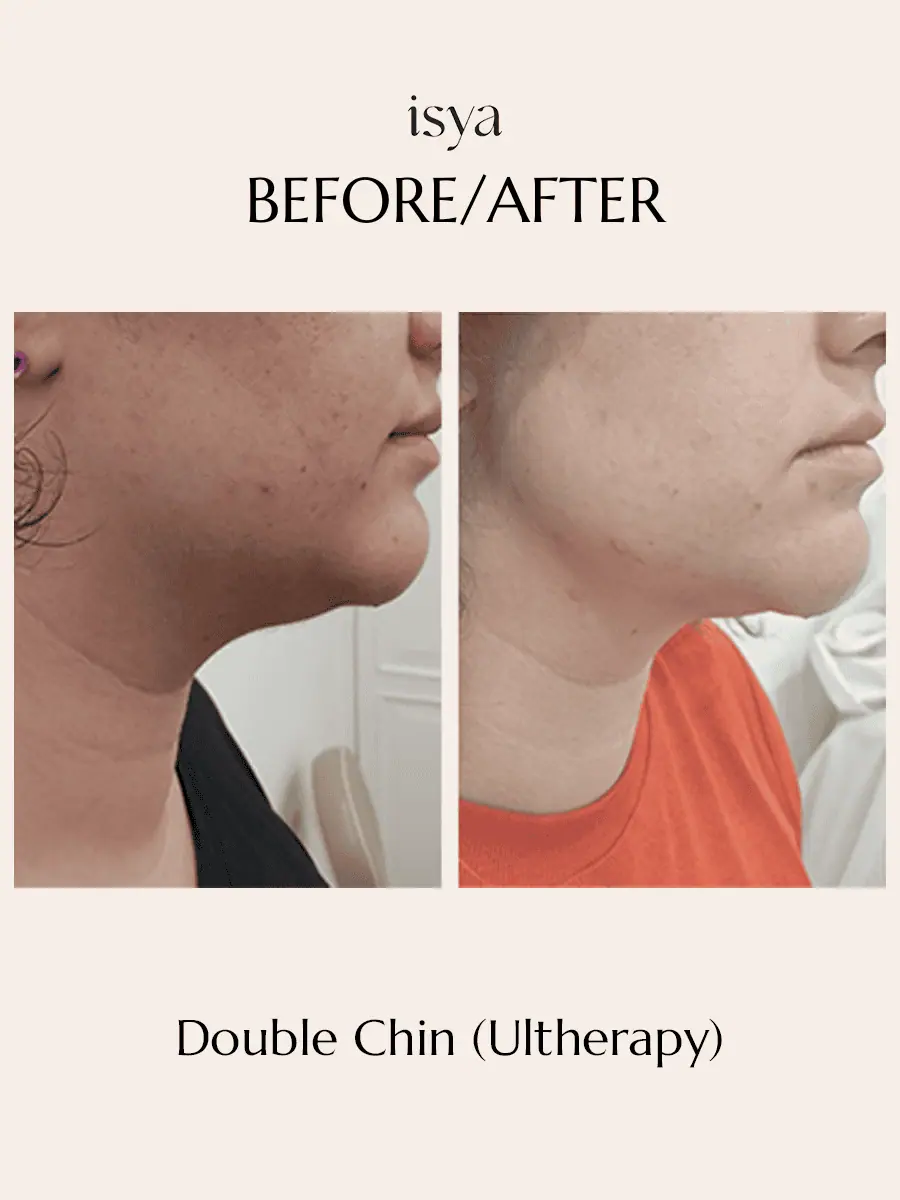 Double Chin Reduction-1