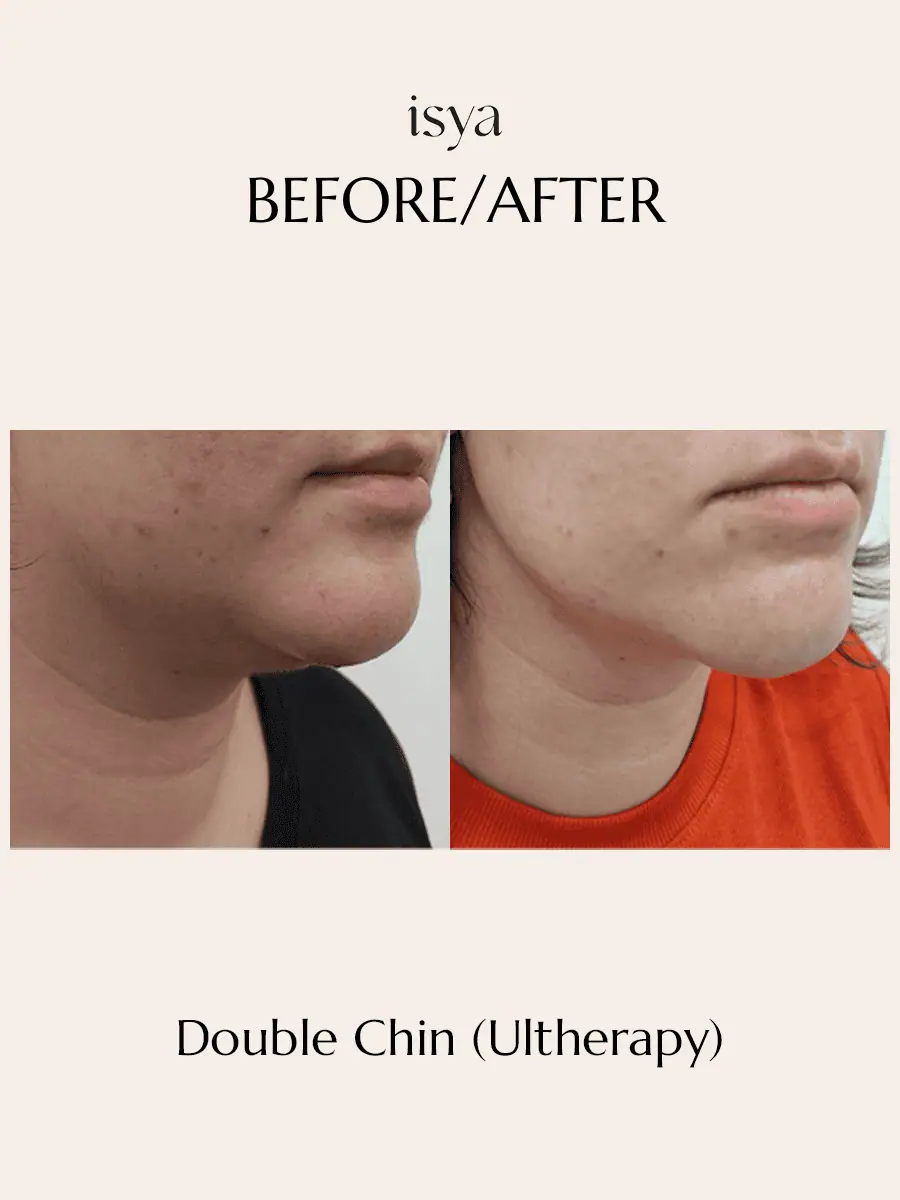 Double Chin Reduction