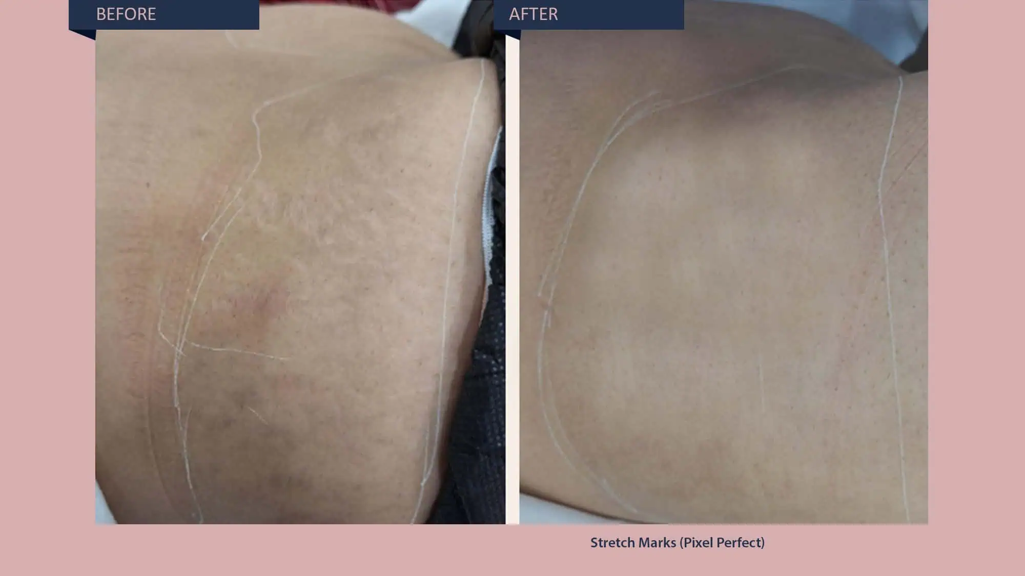 Stretch Marks Treatment -1