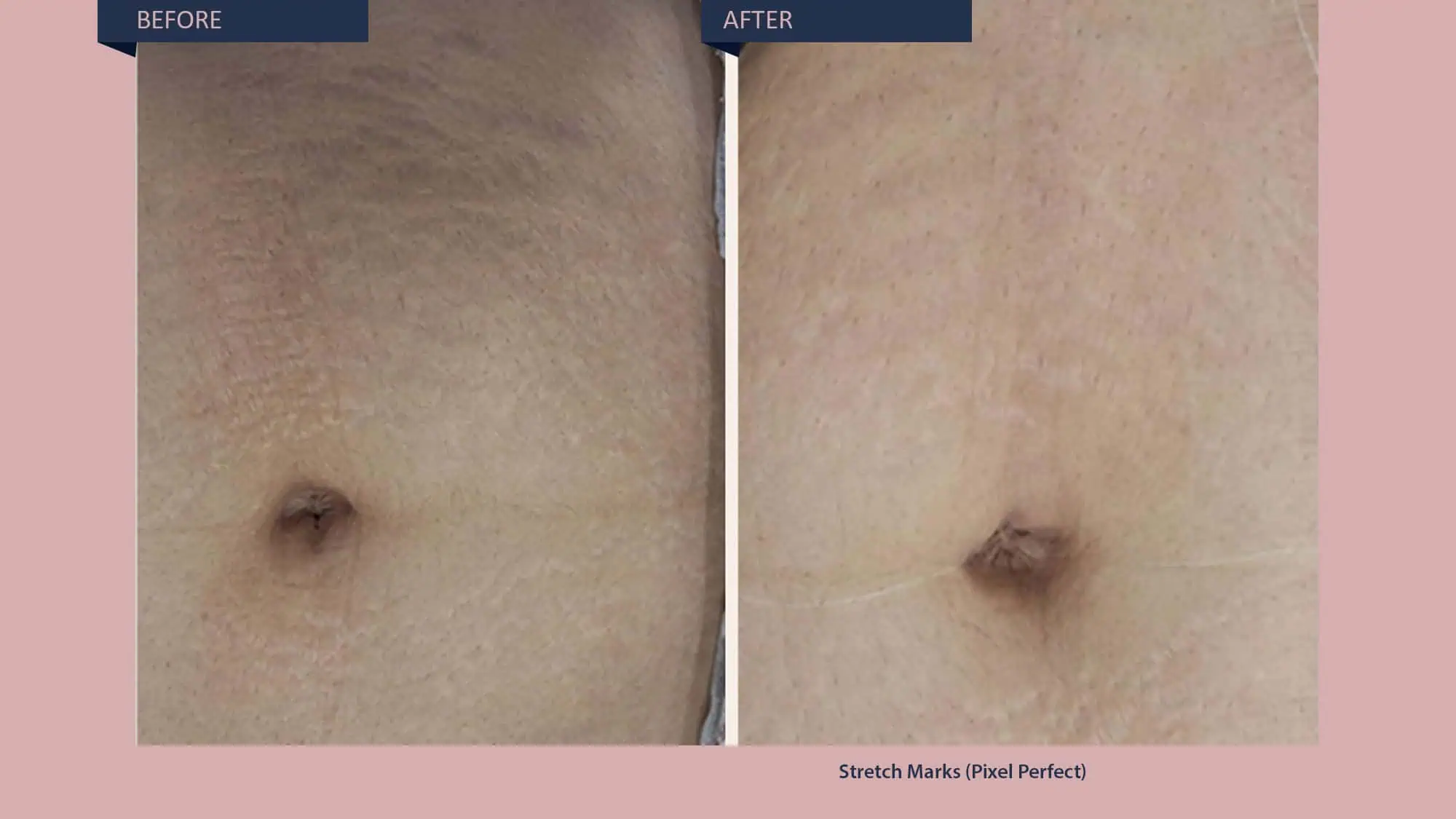 Stretch Marks Treatment