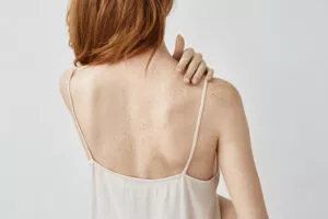 Back Acne Treatments | isyaderm