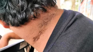 Dark Patches on human neck | Acanthosis Nigricans
