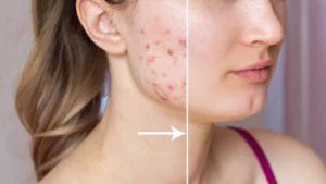 Teen with Before and after acne treatment