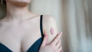 Woman with keloid on hand