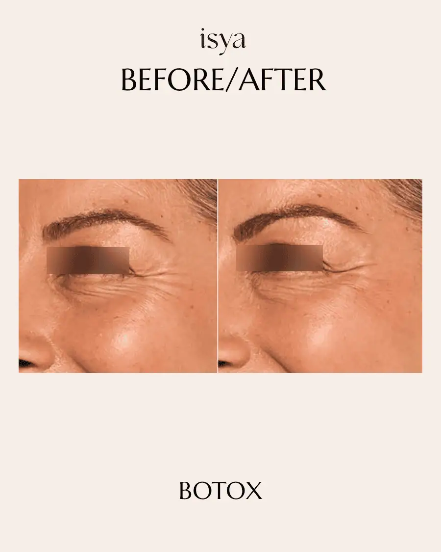 Botox Before & After 1