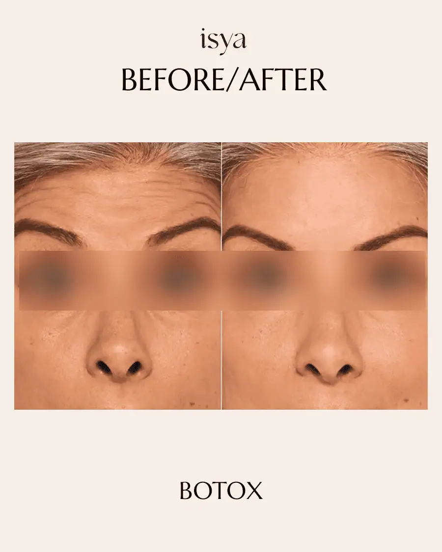 Botox Before & After 2