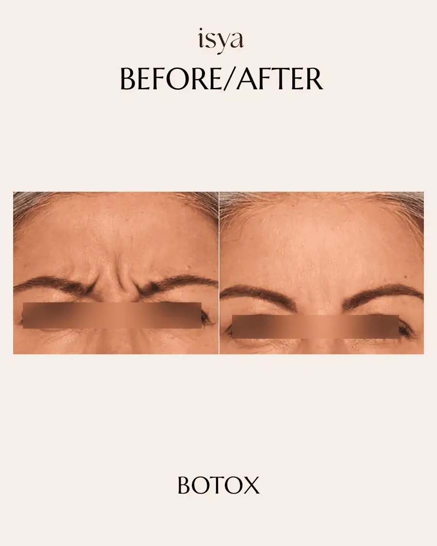 Botox Before & After 3