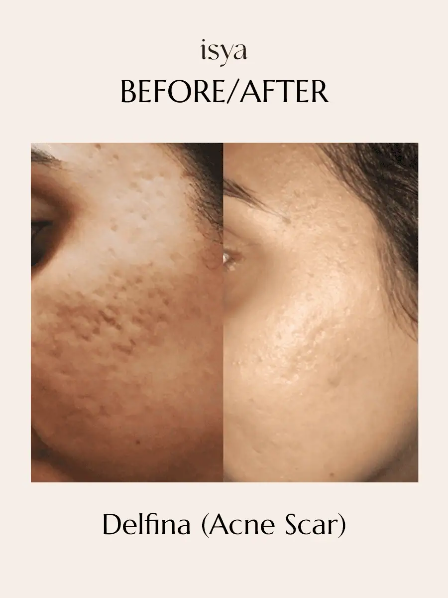 Delfina Before & After 1