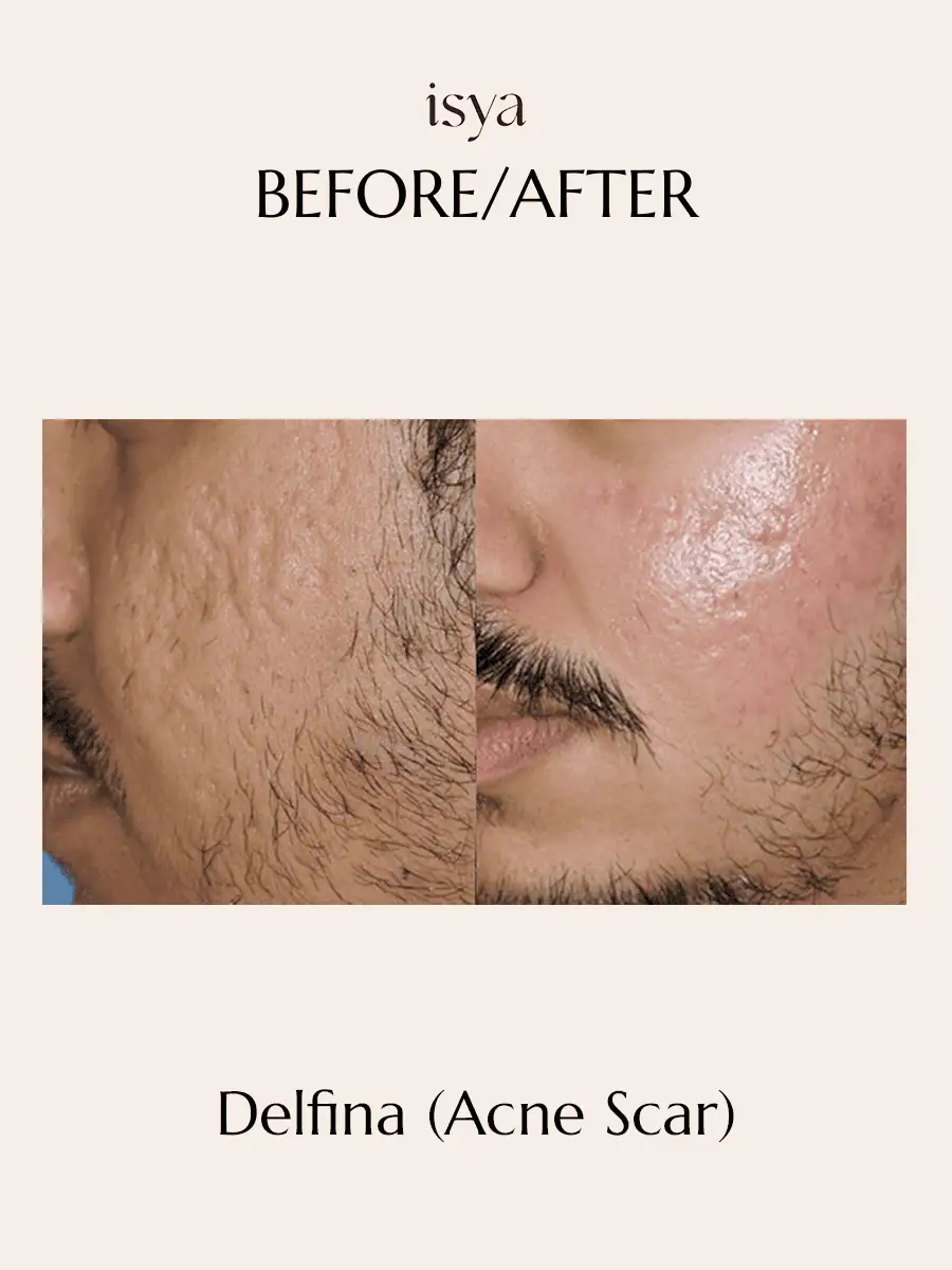 Delfina Before & After 2