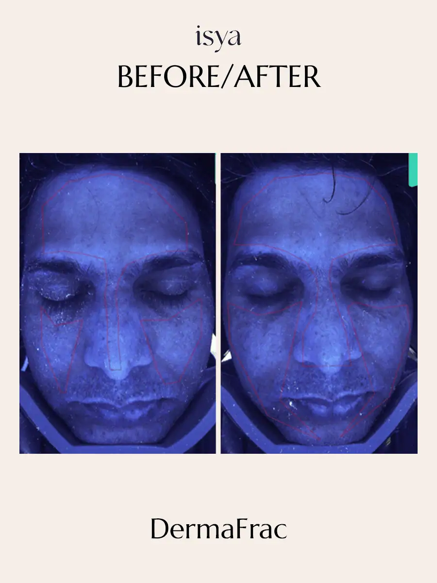 Dermafrac Before & After 1