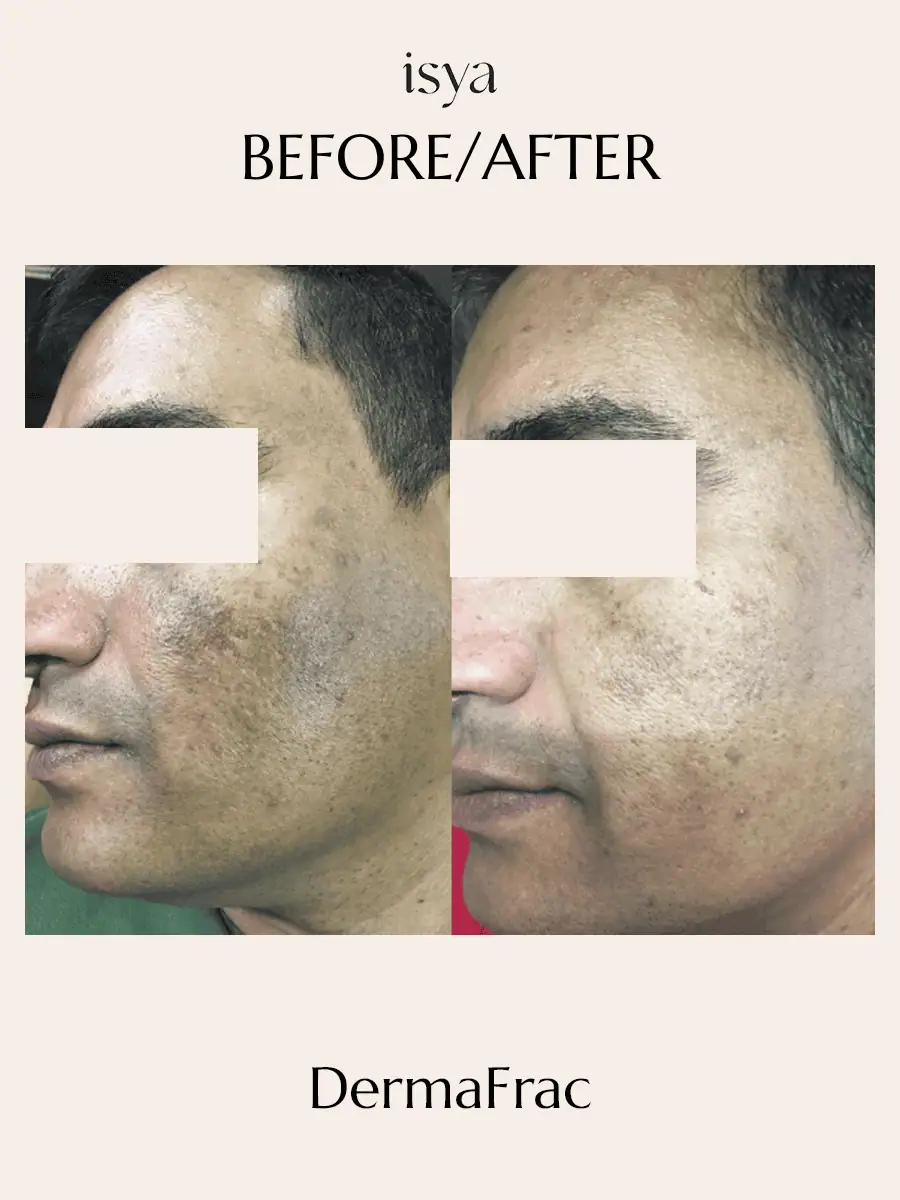 Dermafrac Before & After 2