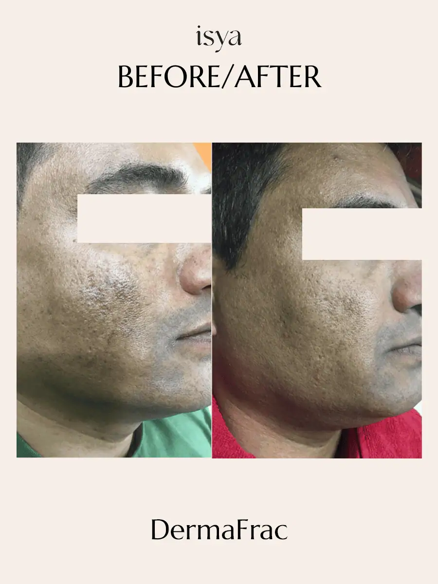 Dermafrac Before & After 3