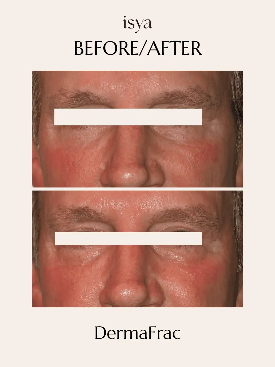 Dermafrac Before & After 4