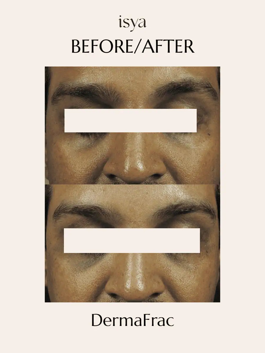 Dermafrac Before & After 6