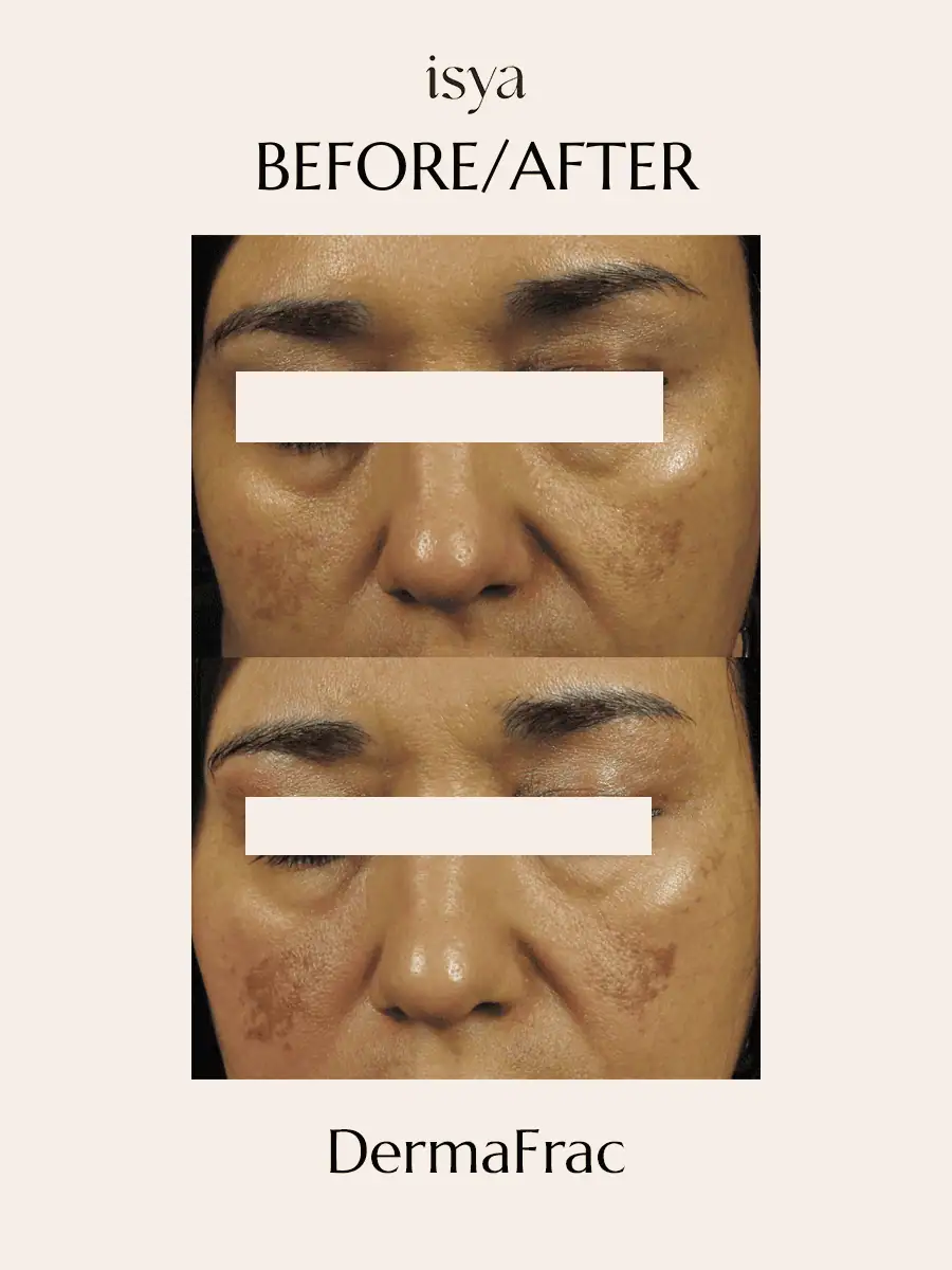 Dermafrac Before & After 7