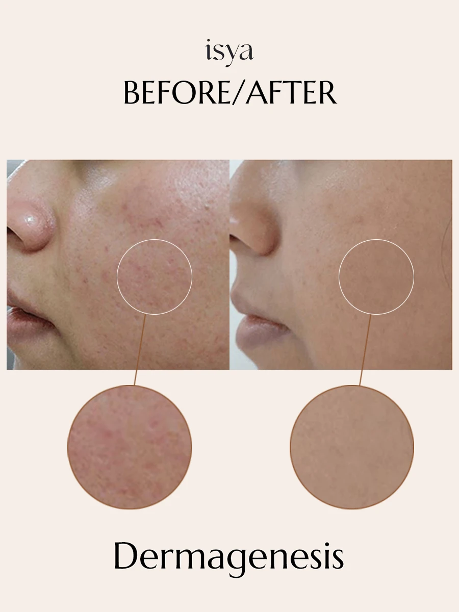 Dermagenesis (1)