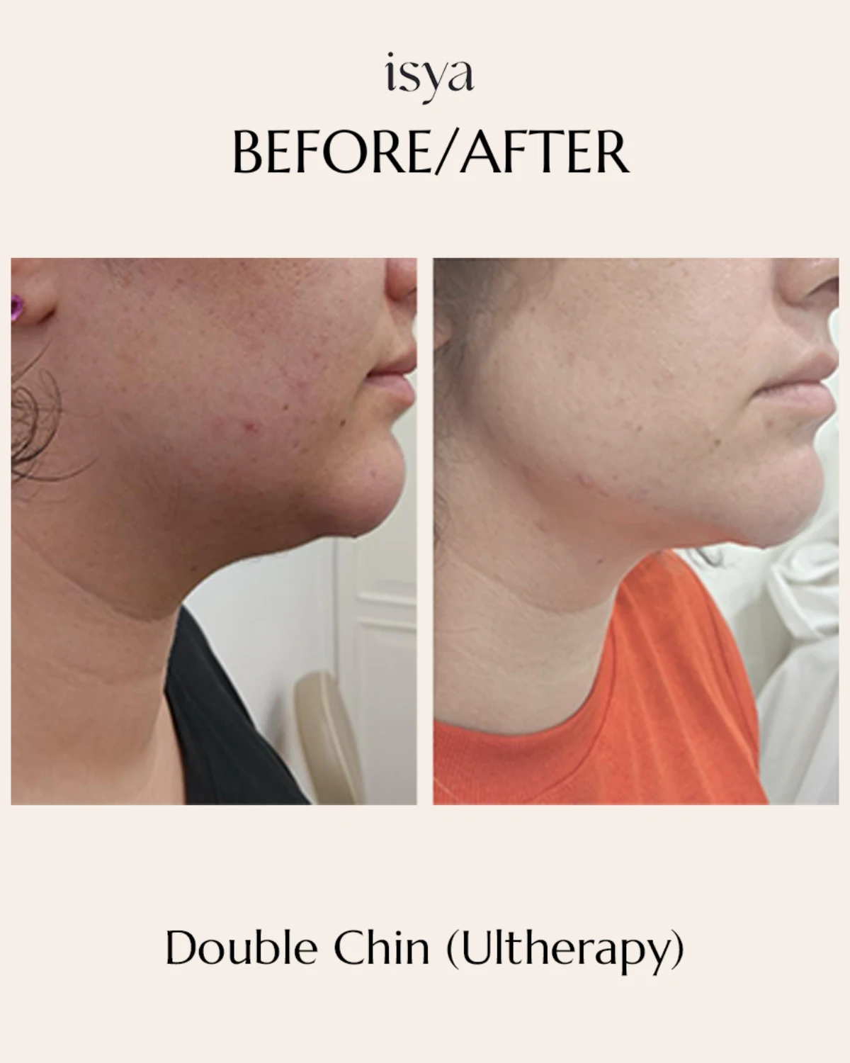 Double Chin (Ultherapy) 2