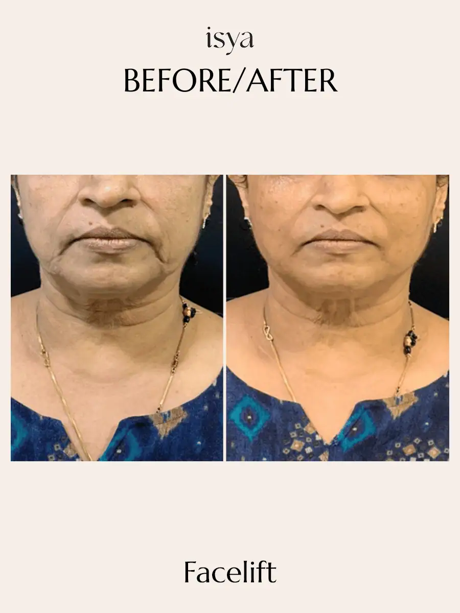 FACELIFT Before & After 1