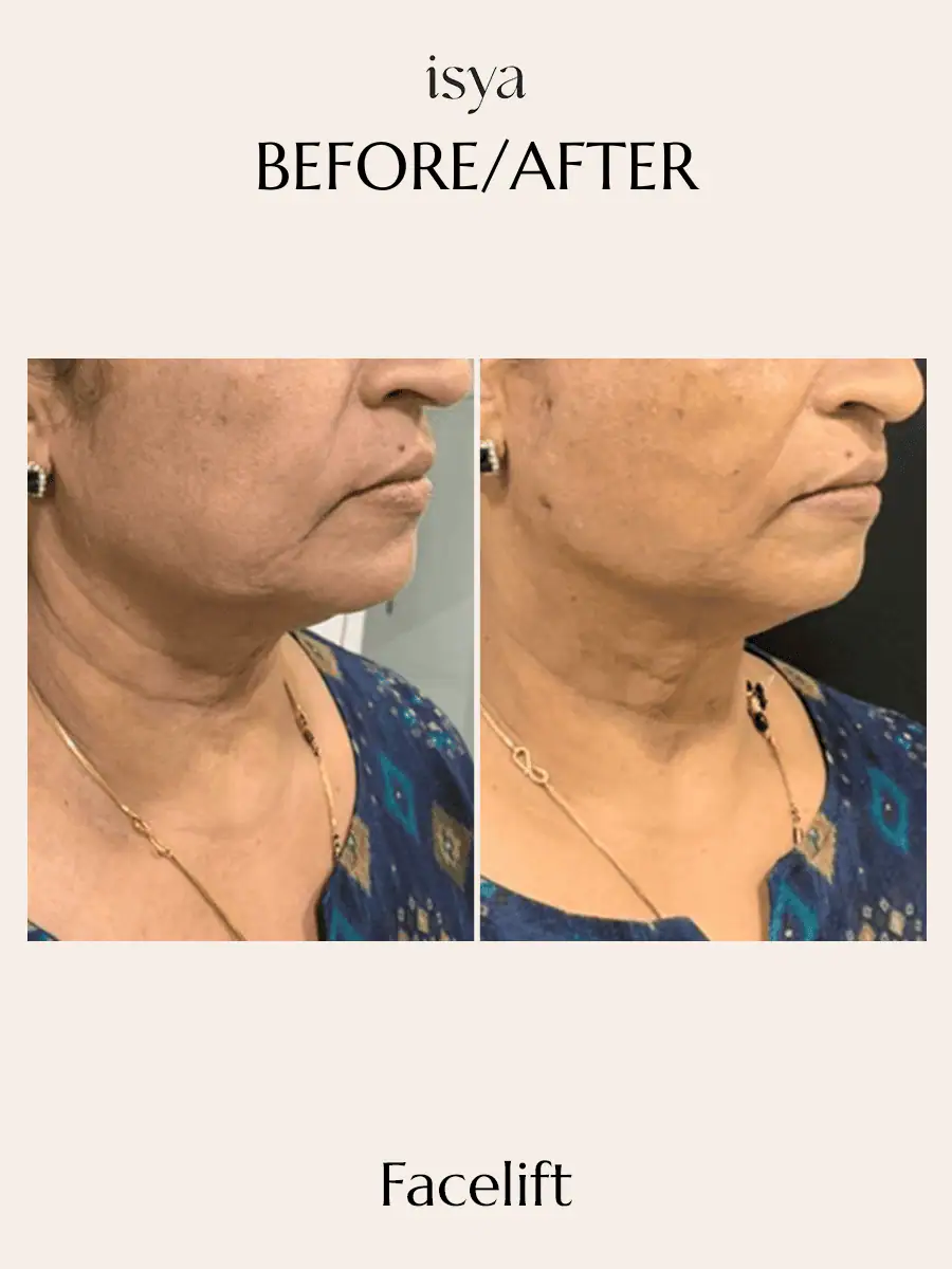 FACELIFT Before & After 2