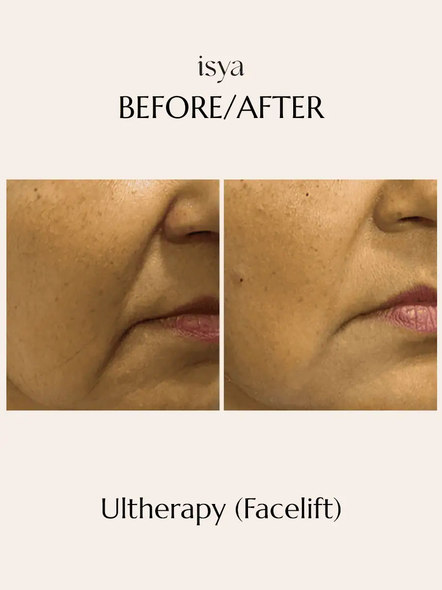 FACELIFT Before & After 3