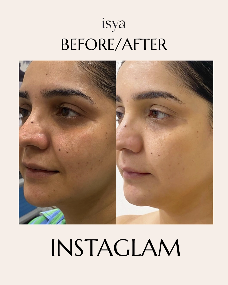 INSTAGLAM Before & After