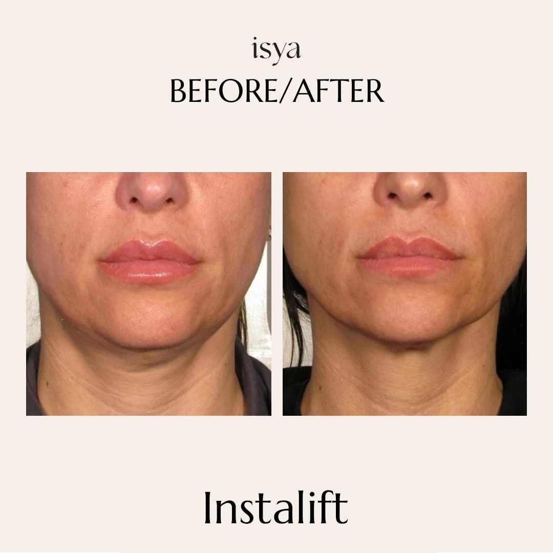 Instalift Before & After
