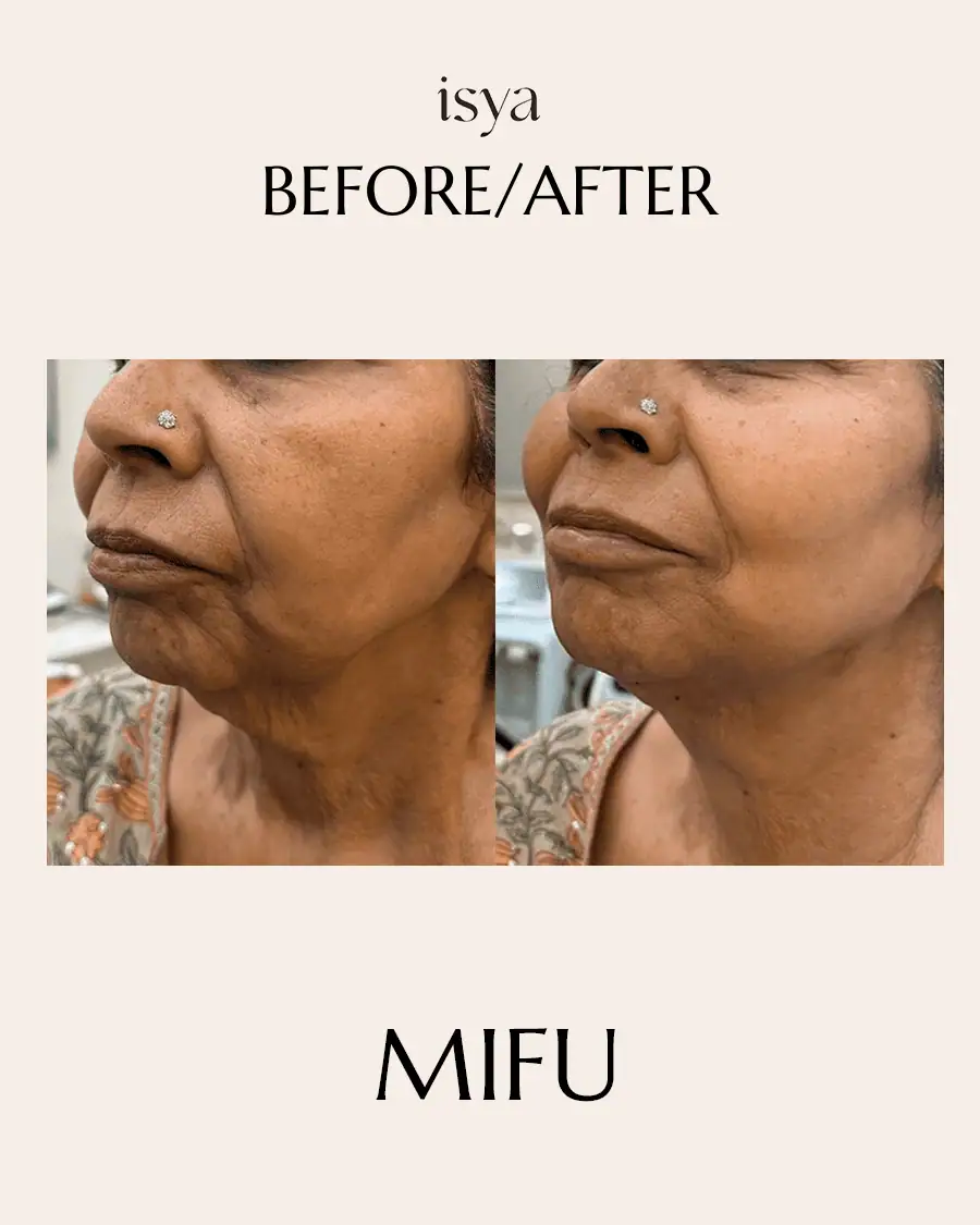 MIFU 1