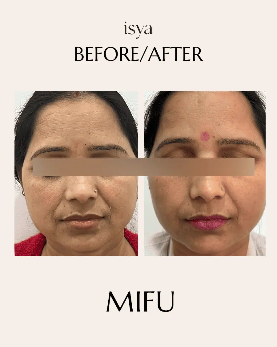 MIFU 2