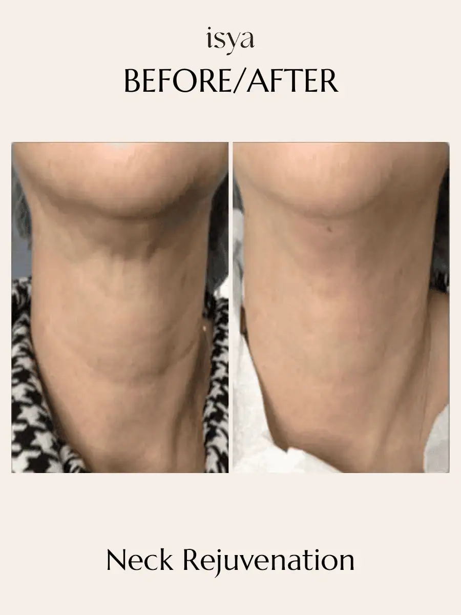 Neck Rejuvenation