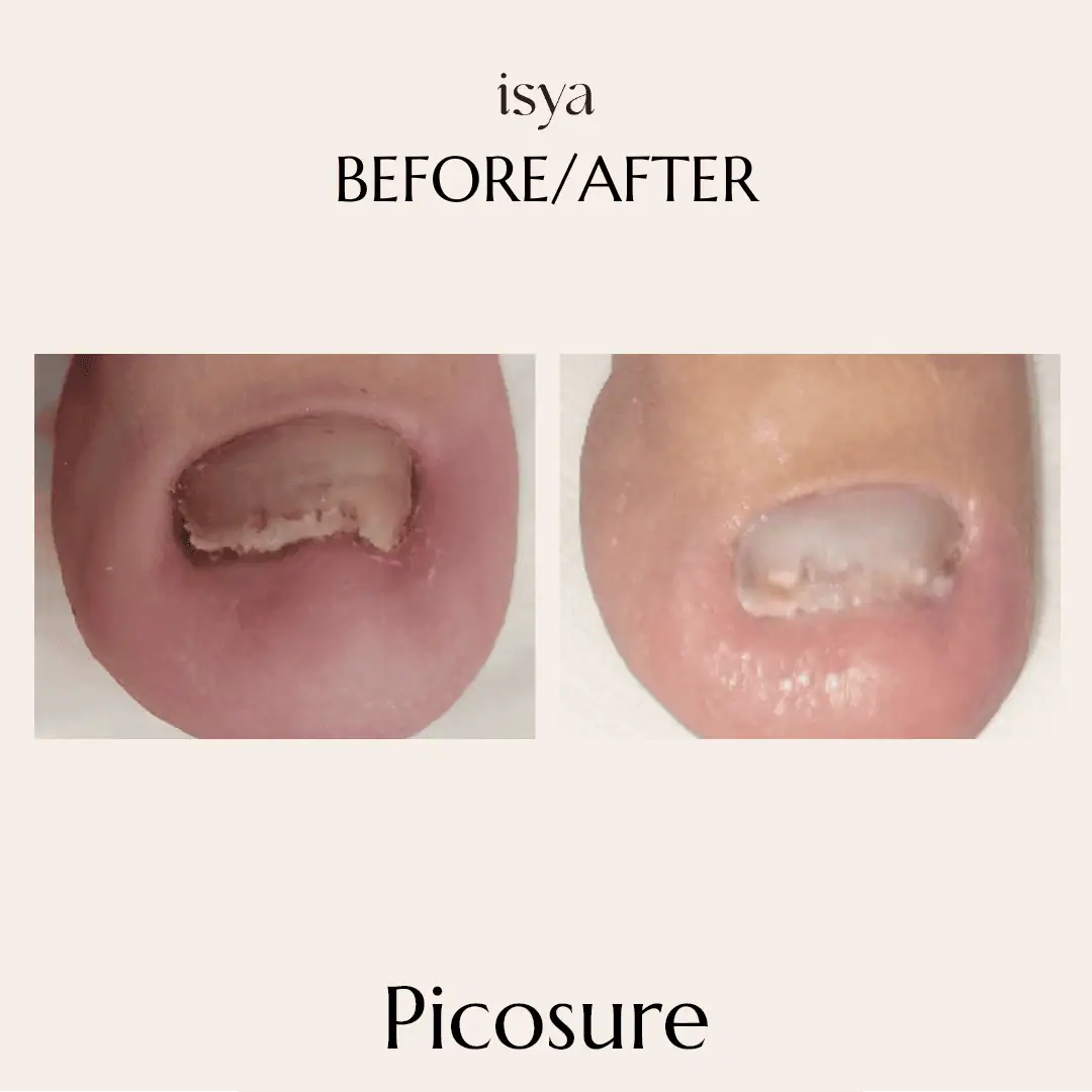 Picosure 1