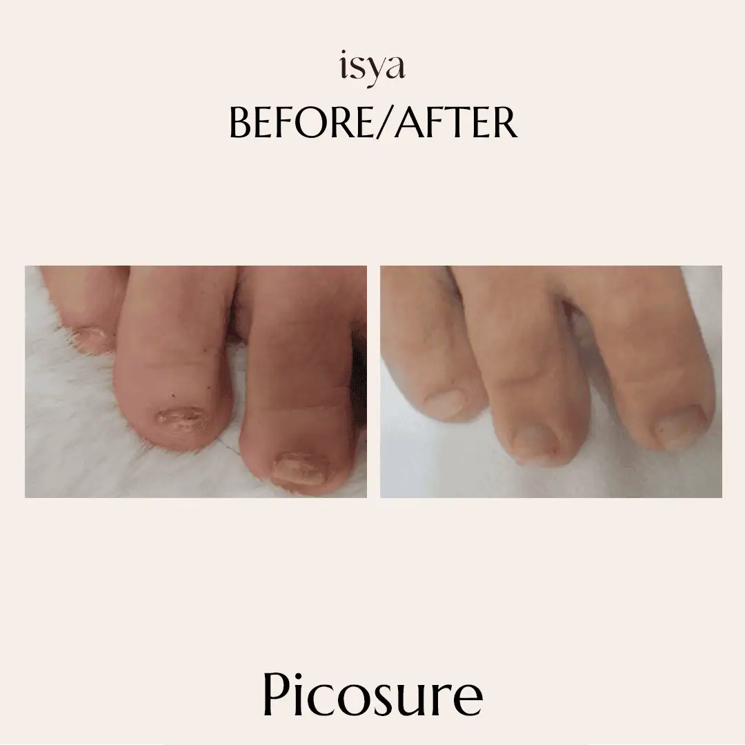 Picosure 2