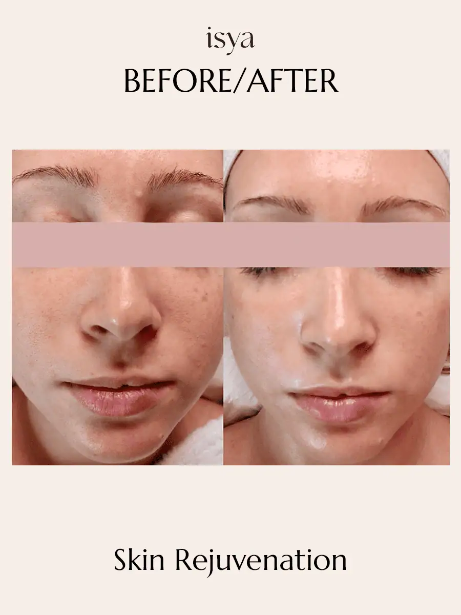Skin Rejuvenation 1
