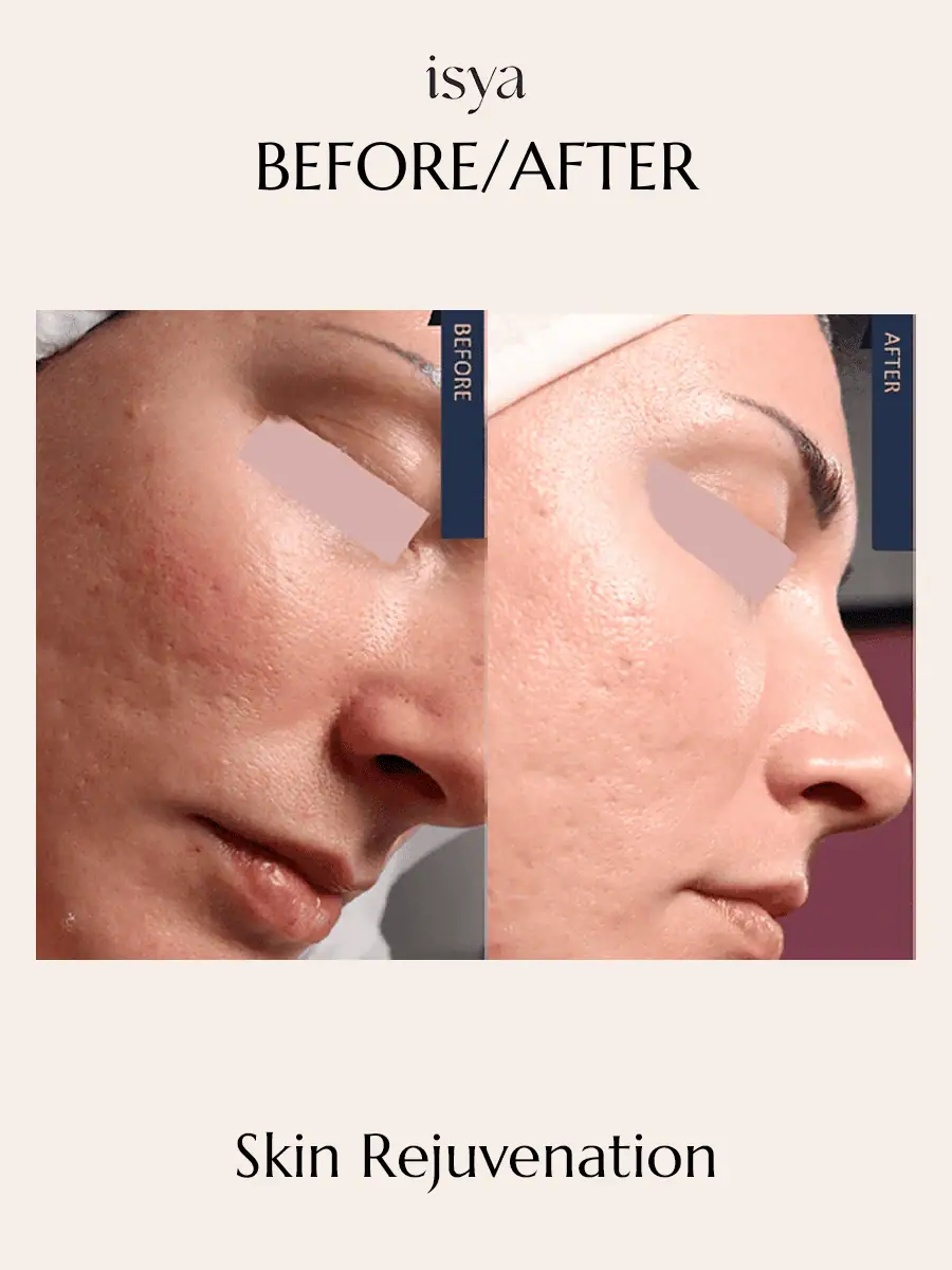 Skin Rejuvenation 2