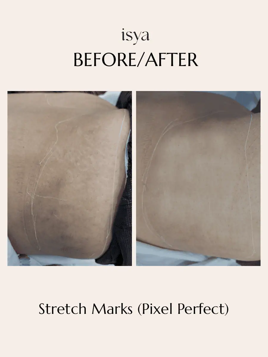 Stretch Marks (Pixel Perfect) 1