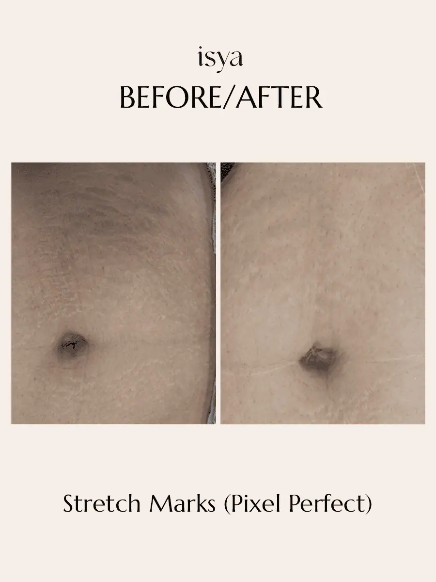 Stretch Marks (Pixel Perfect) 2