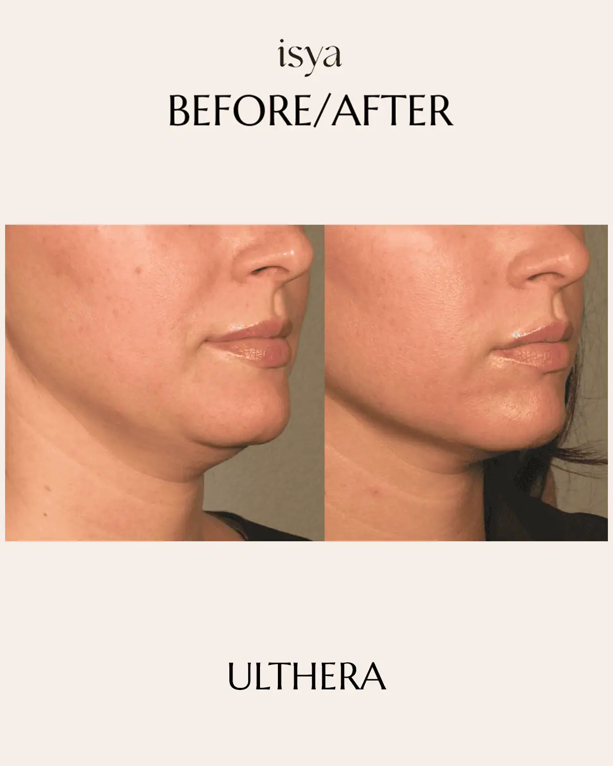 ULTHERA 2