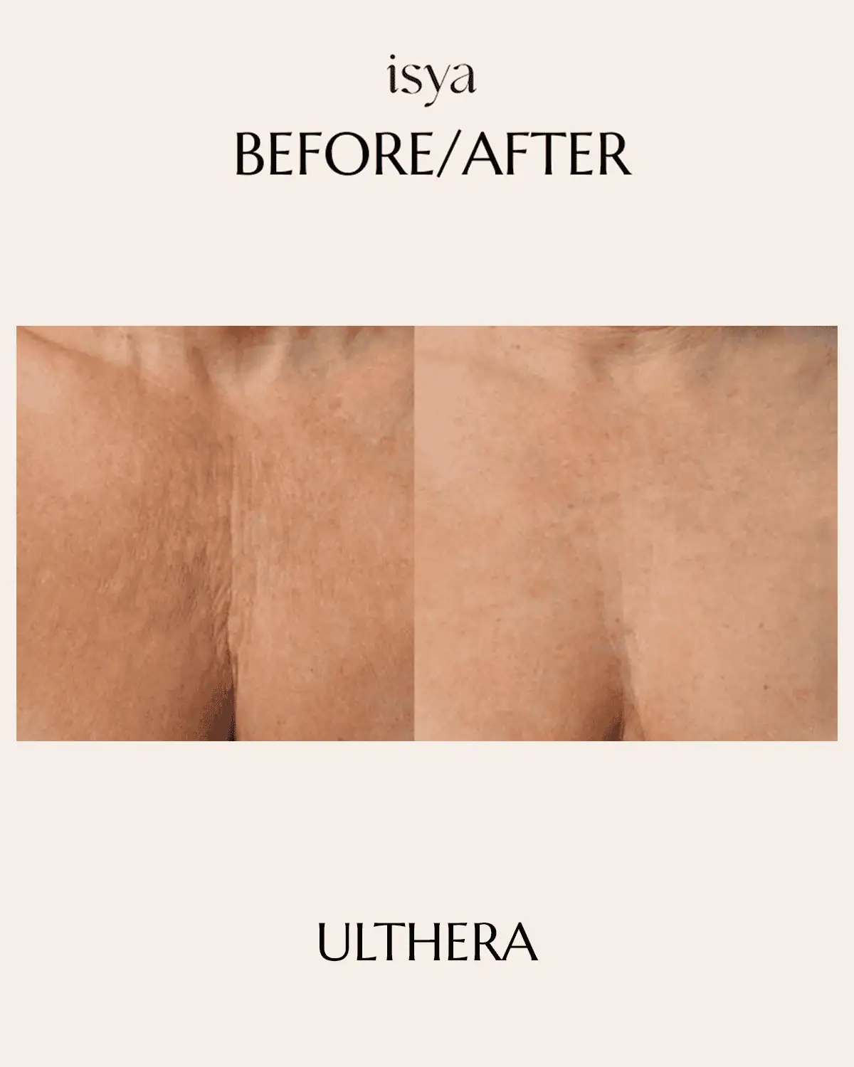 ULTHERA 3