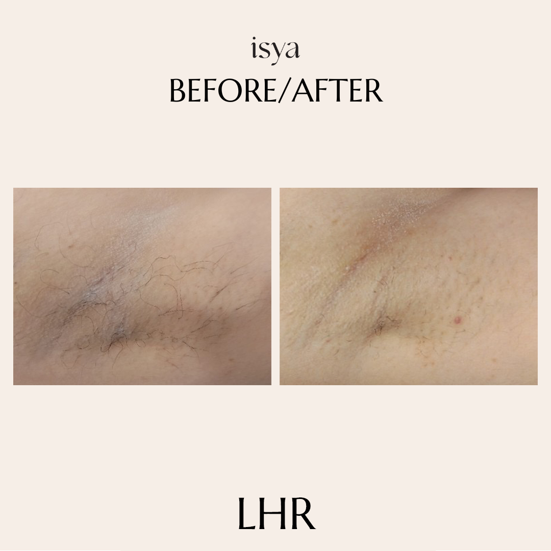 before and after LHR SHWETA TOMAR