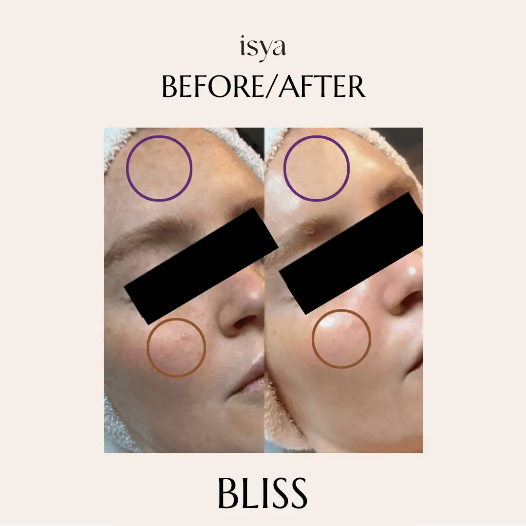 before and after bliss 1