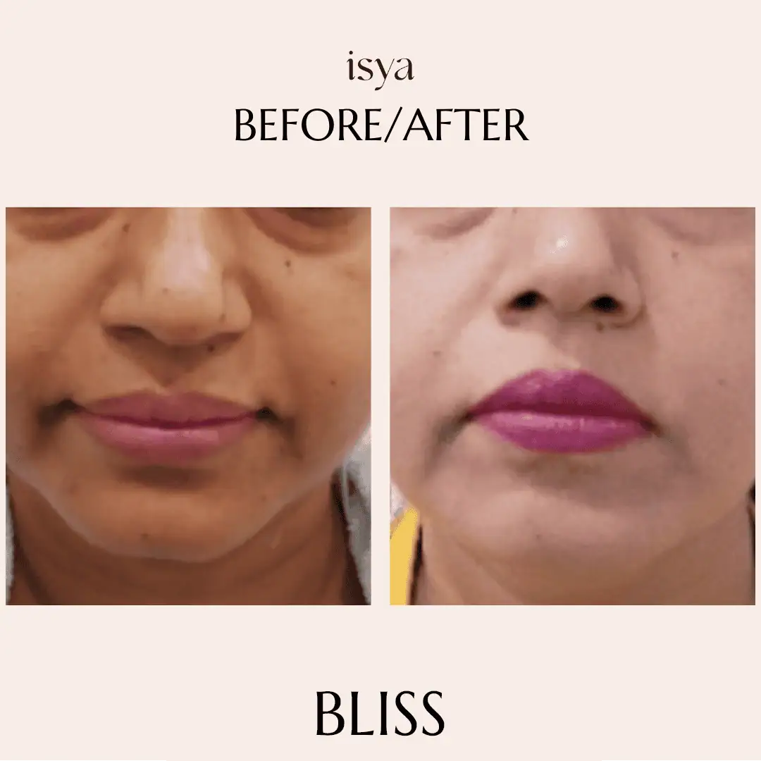 before and after bliss 2