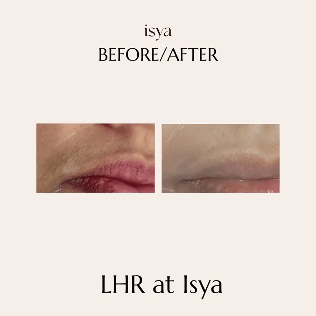 before and after1 lhr 1080x1080