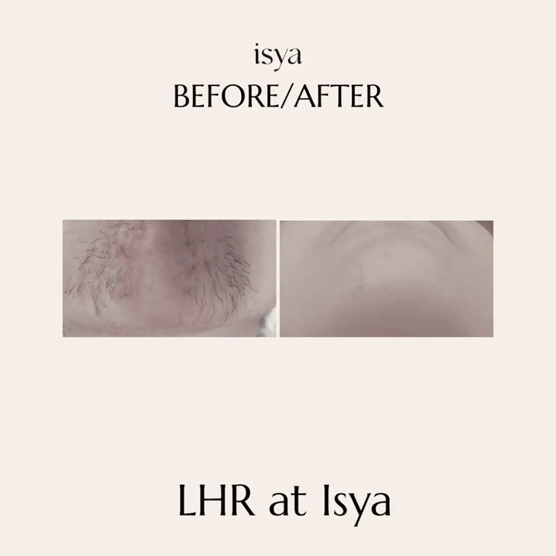 before and after2 lhr 1080x1080