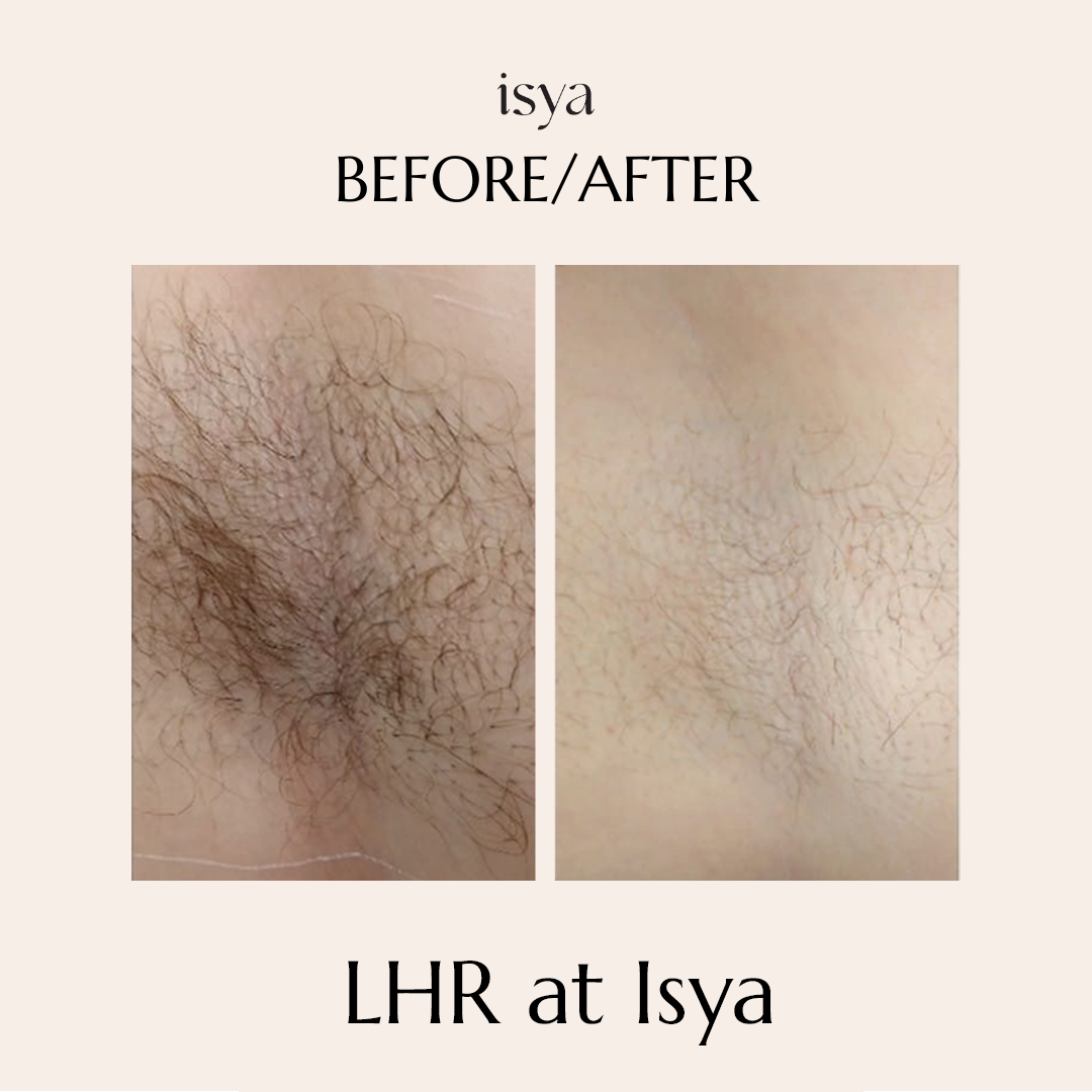 before and after3 lhr