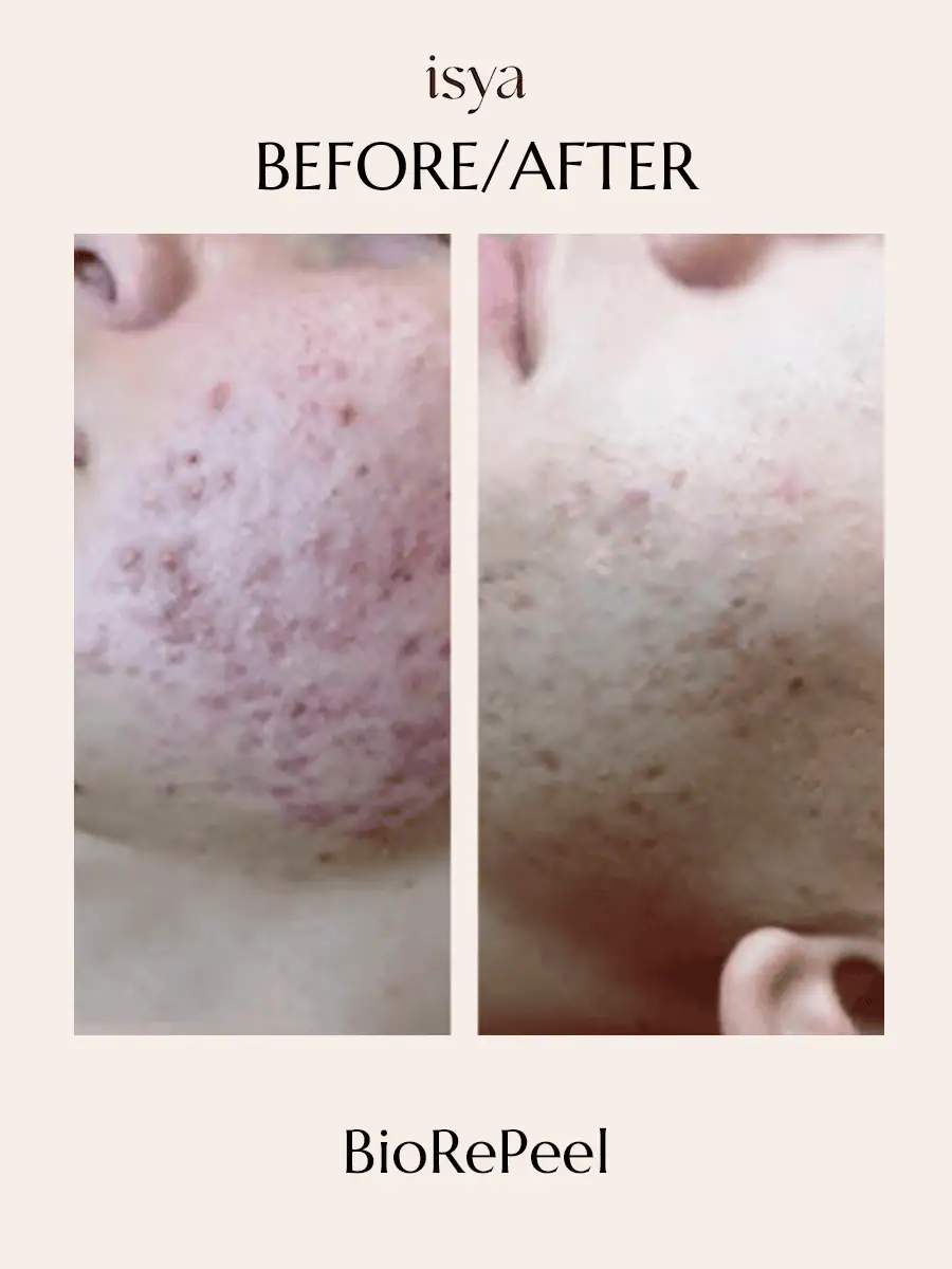 biorepeel6