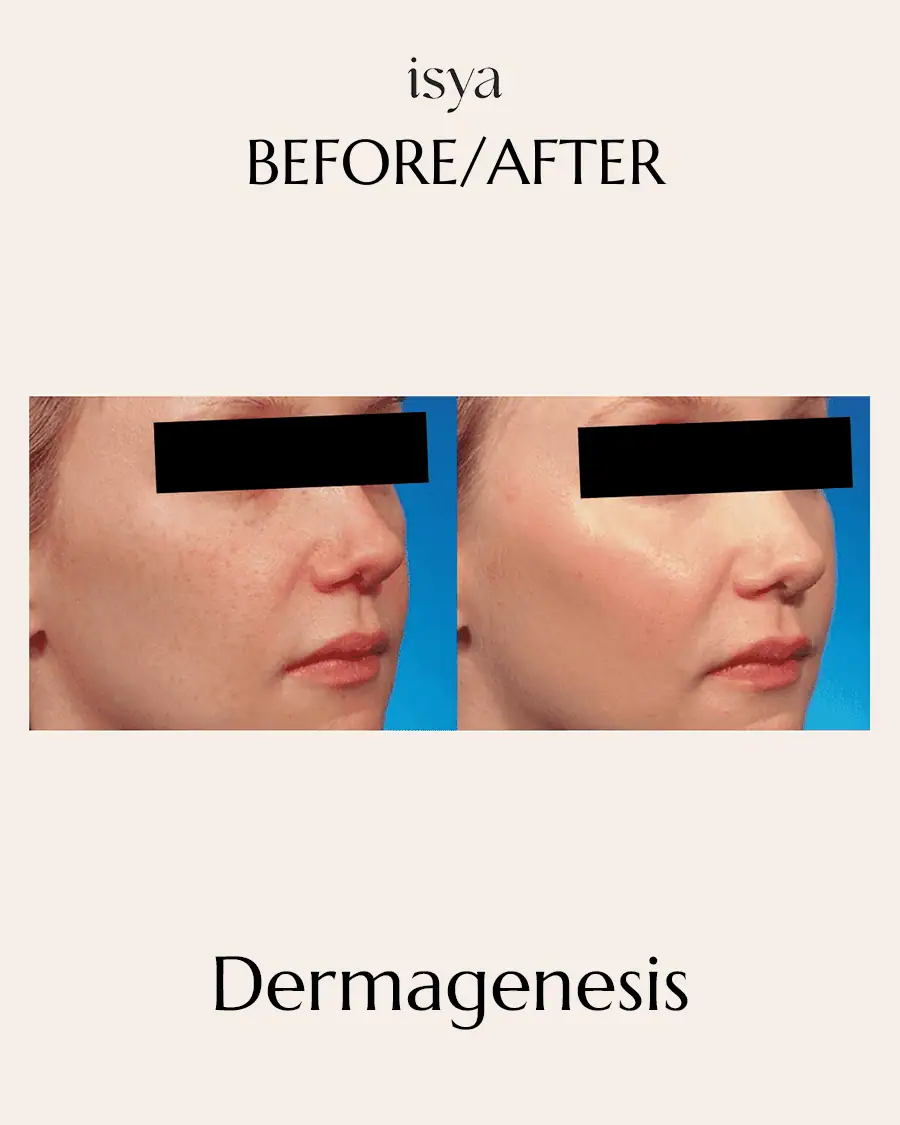 dermagenesis 2