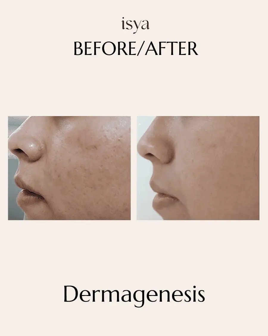 dermagenesis 3