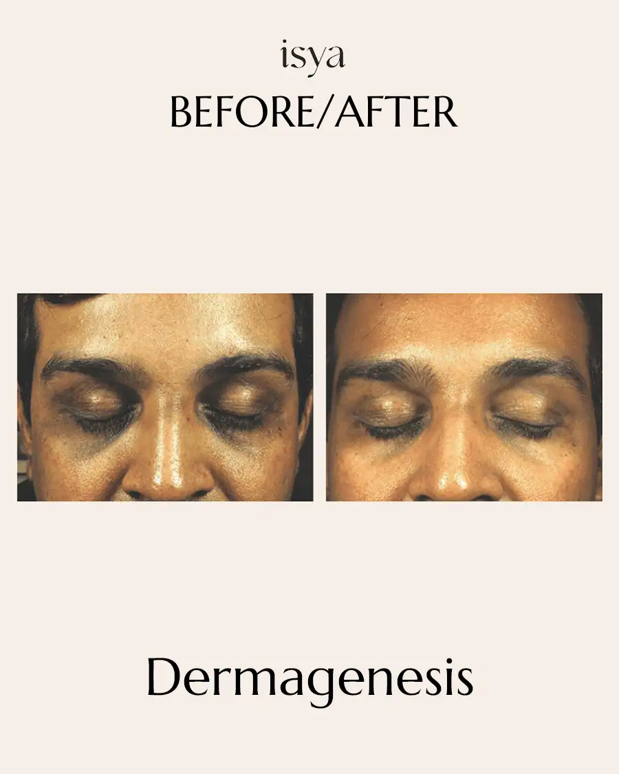 dermagenesis1
