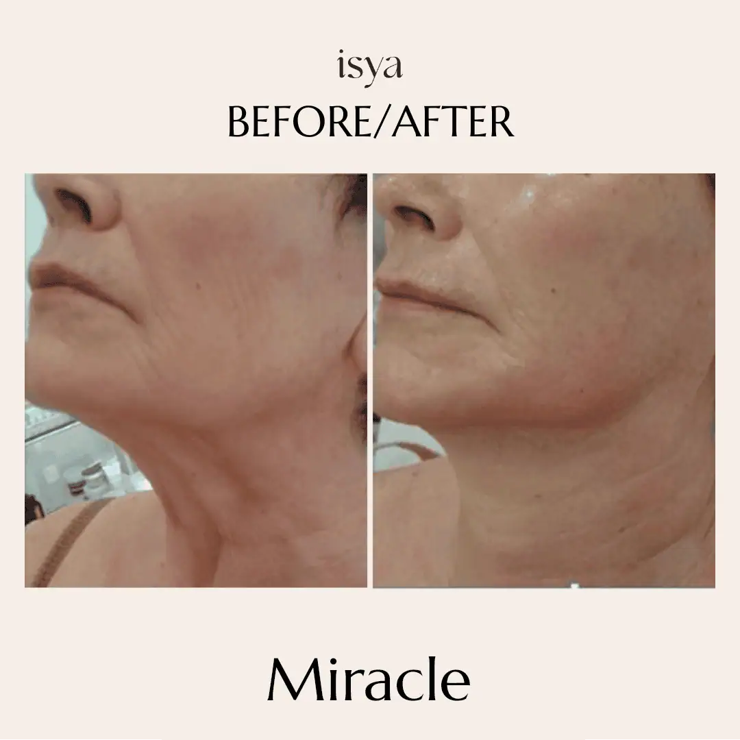 miracle before and after