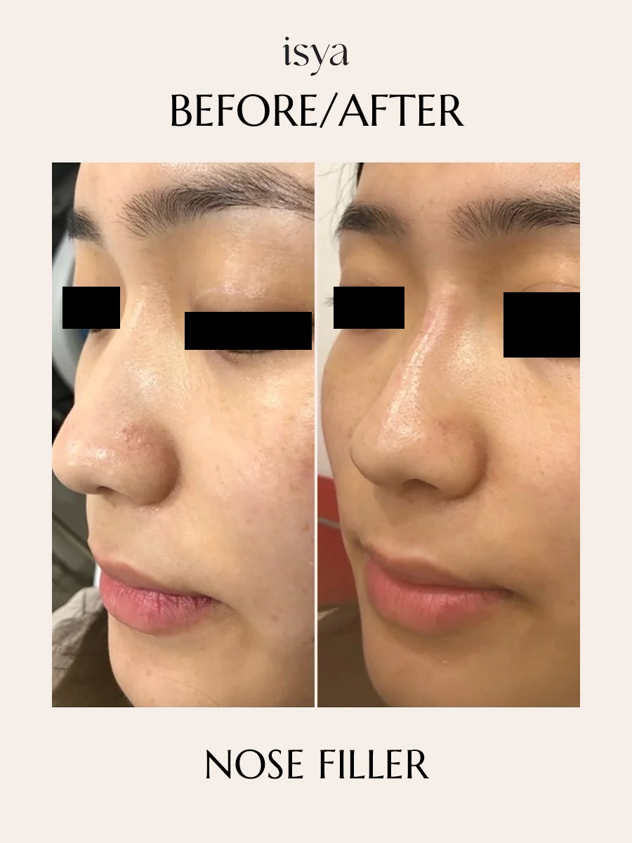 nose filler